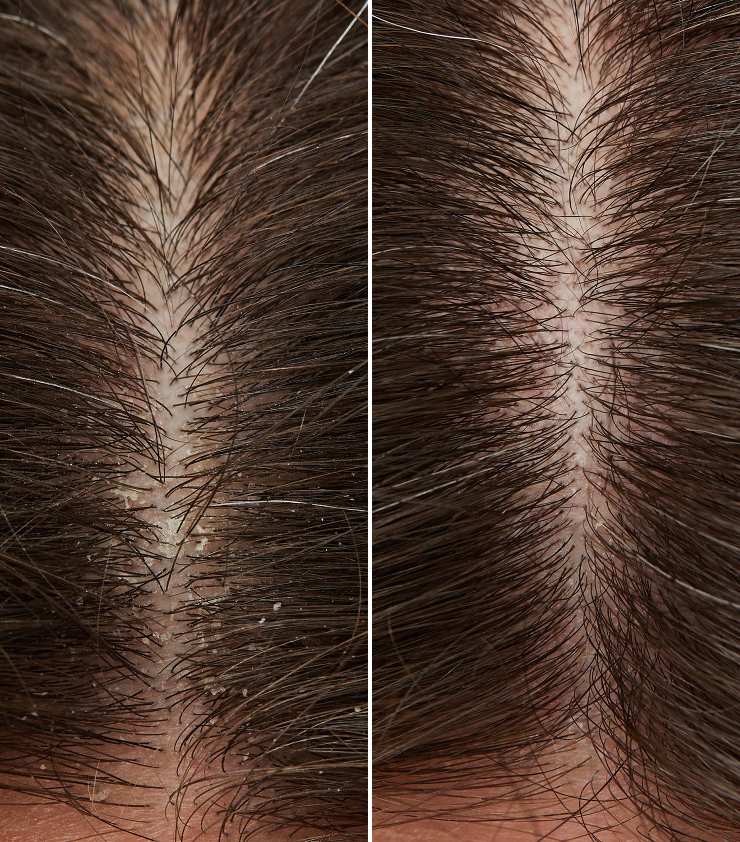 Flaky Itchy Scalp Hydrating Curl Shampoo (1L) NO COLOUR Image 2