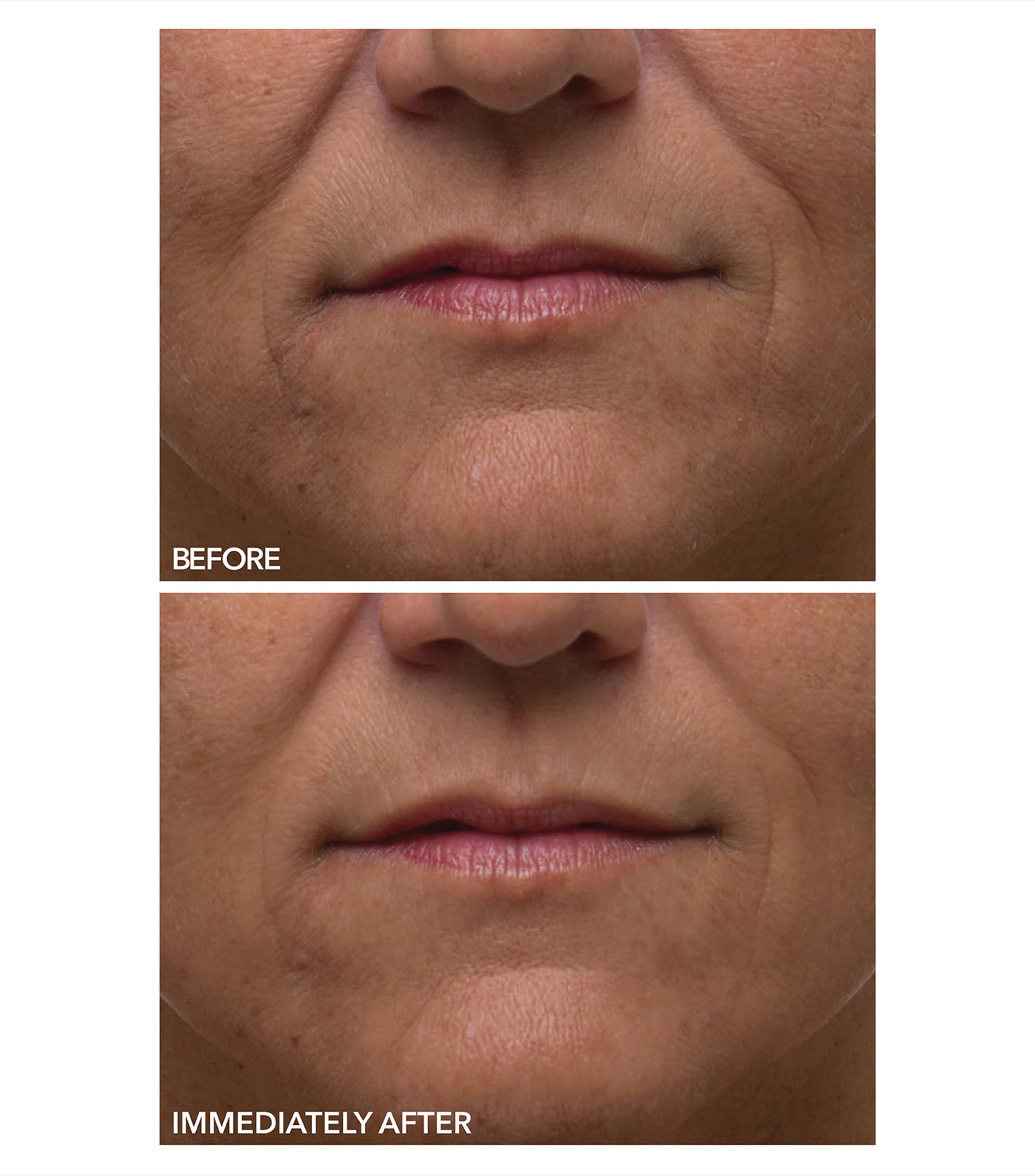 Alpha Beta Gentle Peel (5 Treatments) NO COLOUR Image 2