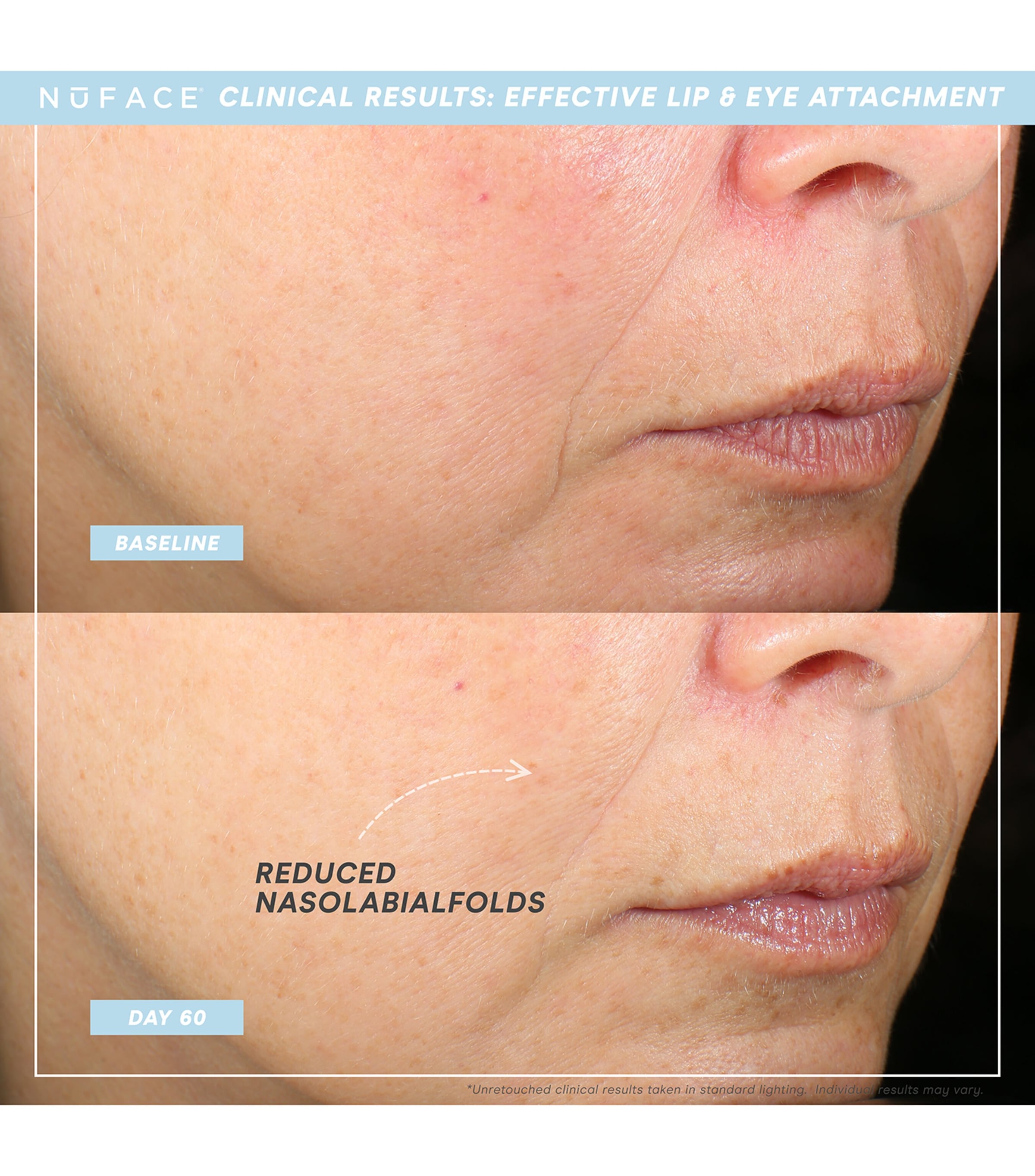 Nuface Trinity+ Eye and Lip Attachment Image 5