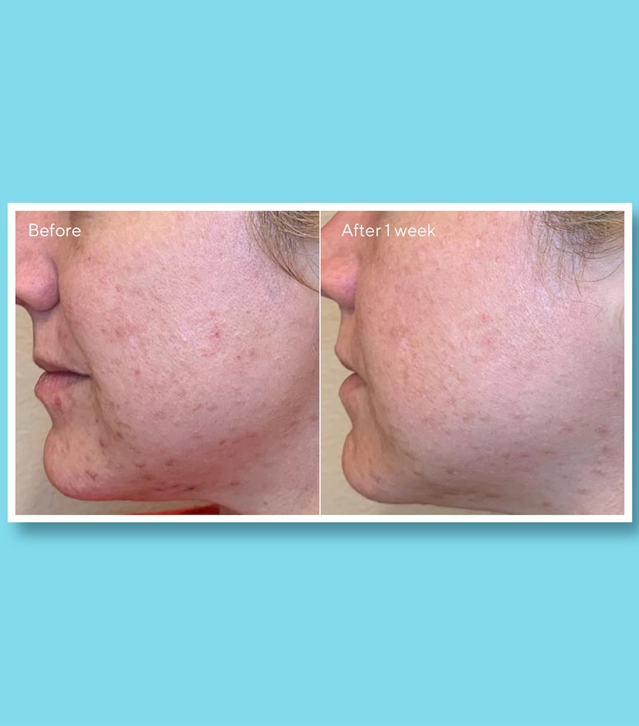 AHA/BHA/Retinoid Daily Clarifying Peel (95ml) NO COLOUR Image 4