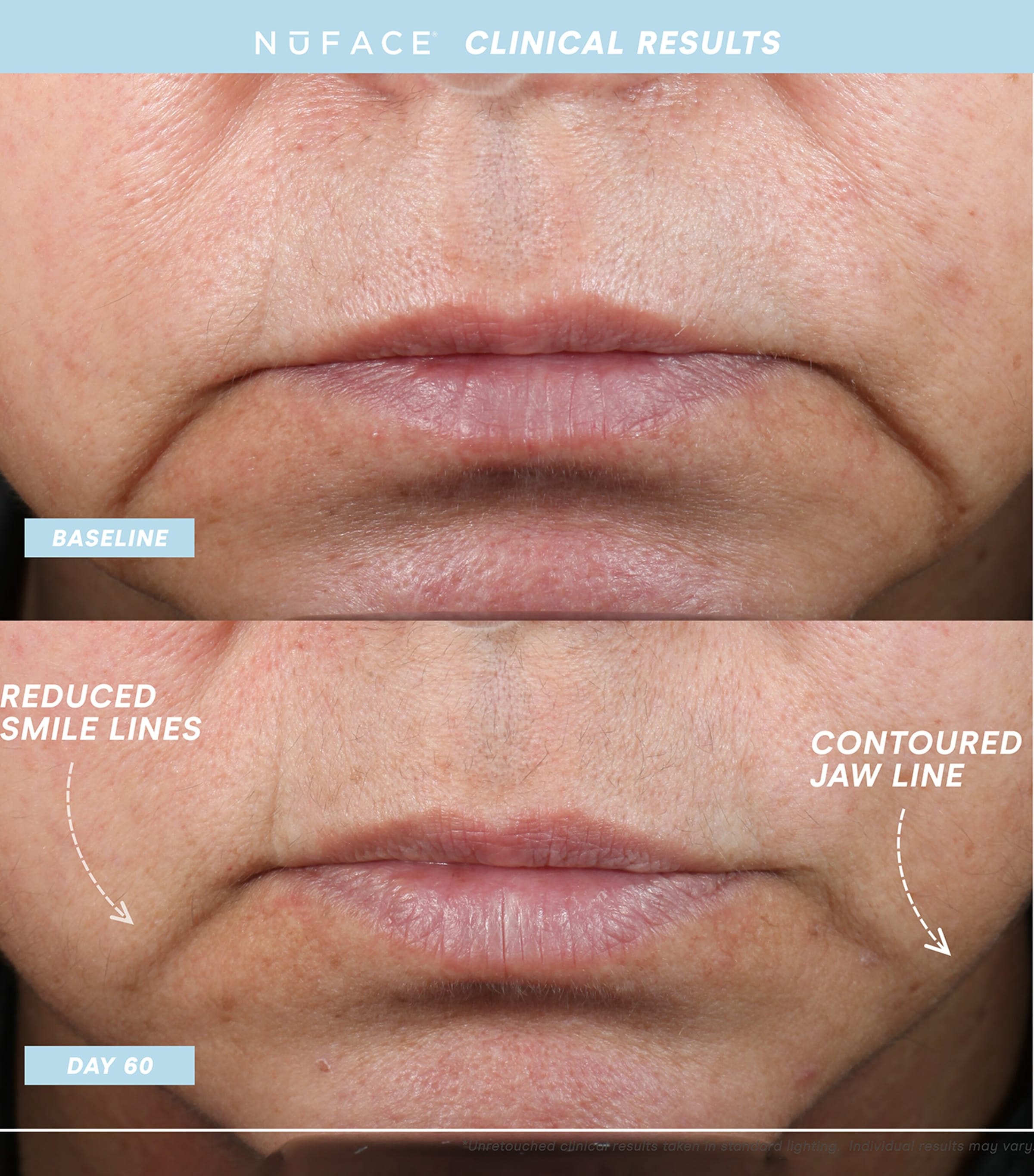 Nuface Trinity+ Eye and Lip Set Image 5