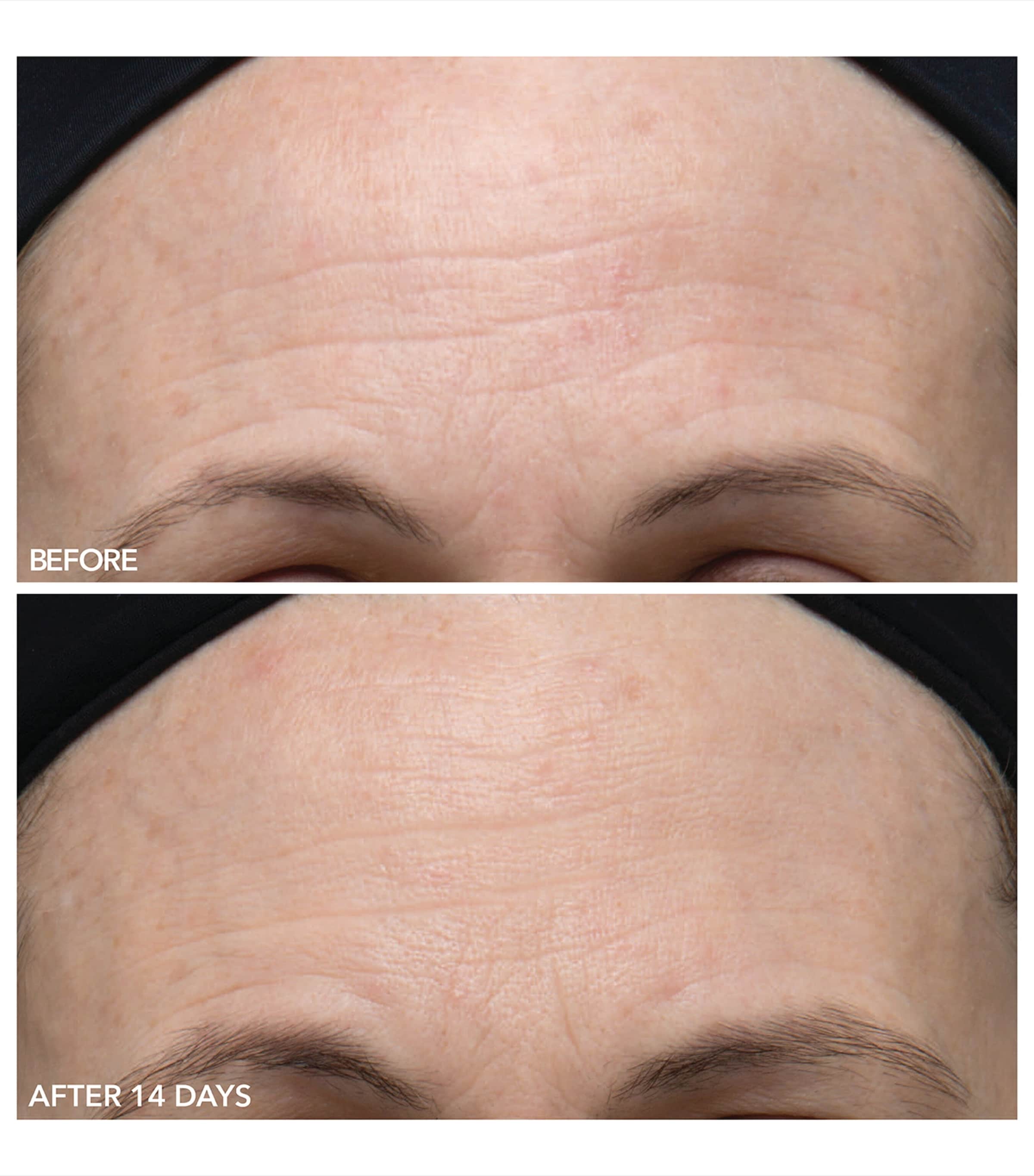 Alpha Beta Gentle Peel (5 Treatments) NO COLOUR Image 3